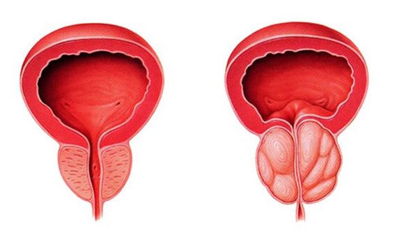 Нормална и възпалена простата (простатит)